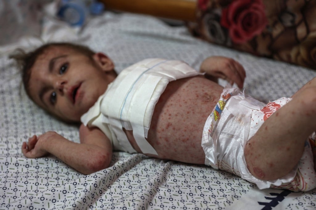 Sarna e piolho se propagam nas crianças em Gaza – Mundo – CartaCapital