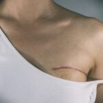 Nova lei garante fisioterapia no SUS a pacientes que retirarem mama – Notícias