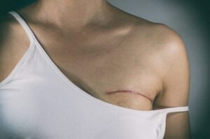 Nova lei garante fisioterapia no SUS a pacientes que retirarem mama - Notícias